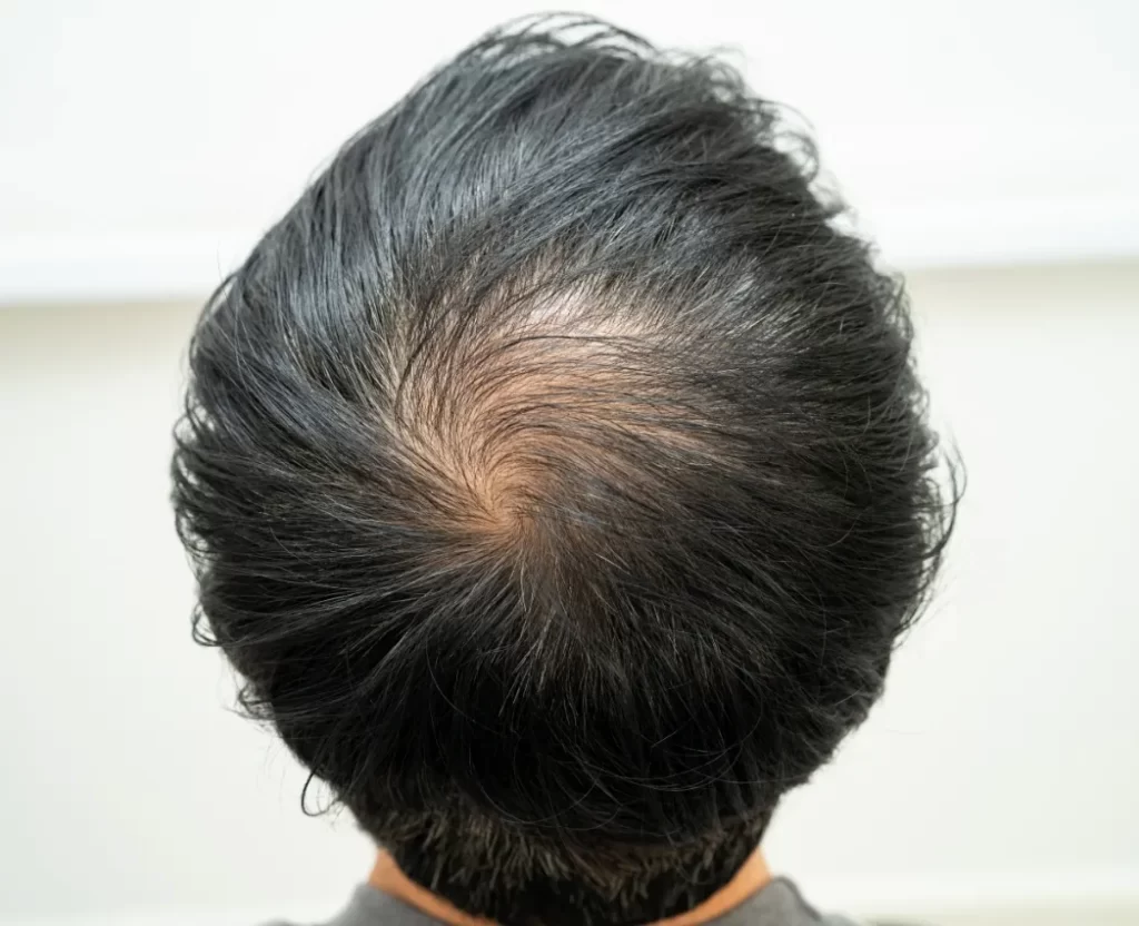 bald in the middle head and begin no loss hair gla utc